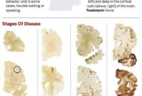 Cte Brain Disease Symptoms Brain Players Nfl Cte Scan Pet Football Scans Damage Imaging Player Study Normal Traumatic Patients Concussions Concussion Chronic Encephalopathy Disease