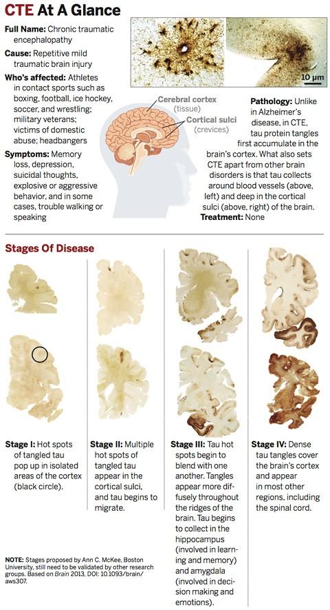 Cte Brain Disease Symptoms Brain Players Nfl Cte Scan Pet Football Scans Damage Imaging Player Study Normal Traumatic Patients Concussions Concussion Chronic Encephalopathy Disease