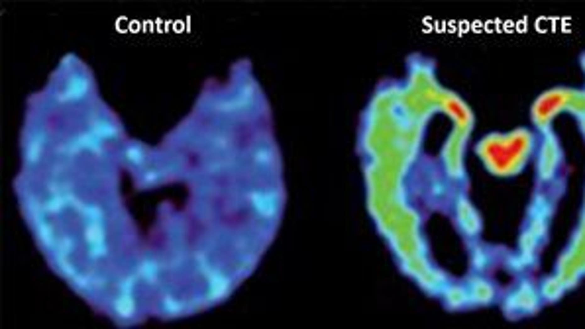 In first, a patient with CTE but no brain injury | Fox News
