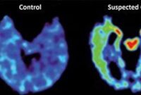 Cte Brain Injury How Cte Affects The Brain