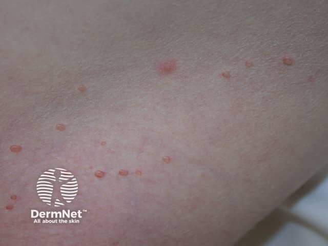 Davis Cup 2025 Dates – Your comprehensive guide to understanding molluscum contagiosum …