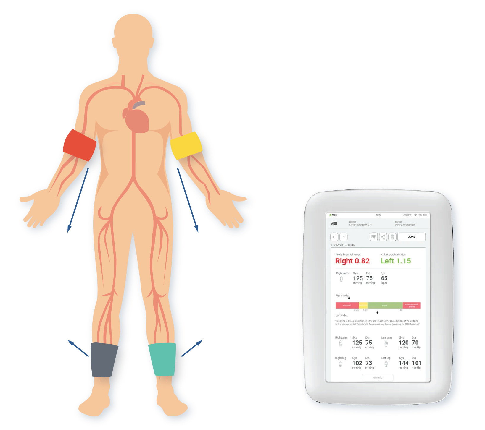  Ankle-Brachial Index (ABI) Test for PAD 