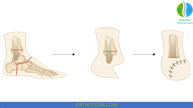 Copa De Brasil 2025 – Syme amputation for limb salvage: early experience with 26 cases