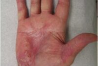 Math Worksheets For Kids Pdf psoriasis palms of Hands Global Skin Atlas Diagnosis Detail Math Worksheets For Kids Pdf psoriasis palms of Hands Global Skin Atlas Diagnosis Detail