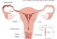 Tracing 5 Worksheet Using A mirena For Birth Control