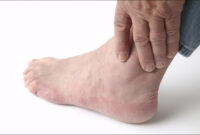 Cut And Paste Math Worksheets Anatomical Model- foot gout