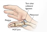 Dinosaur Activities For Preschoolers Thumb Ulnar Collateral Ligament Tear – Julian Carlo, Md.