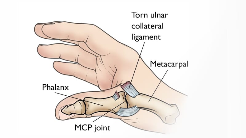 Dinosaur Activities For Preschoolers Thumb Ulnar Collateral Ligament Tear – Julian Carlo, Md.