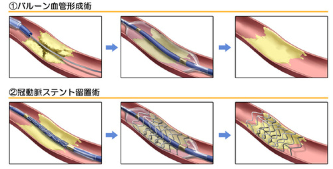 Ultimate Pets Home Office Weekly In Austria 狭心症・心筋梗塞に対するカテーテル治療（percutaneous Coronary Intervention; Pci）