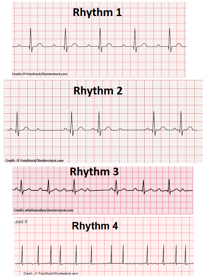  atrial-fibrillation 
