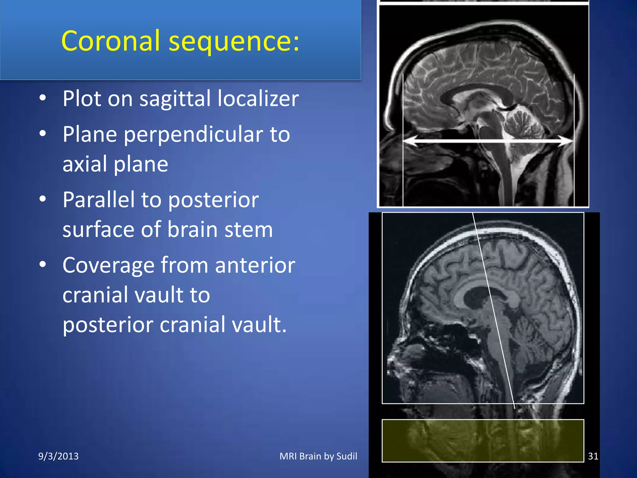 MRI Procedure of Brain | PPTX