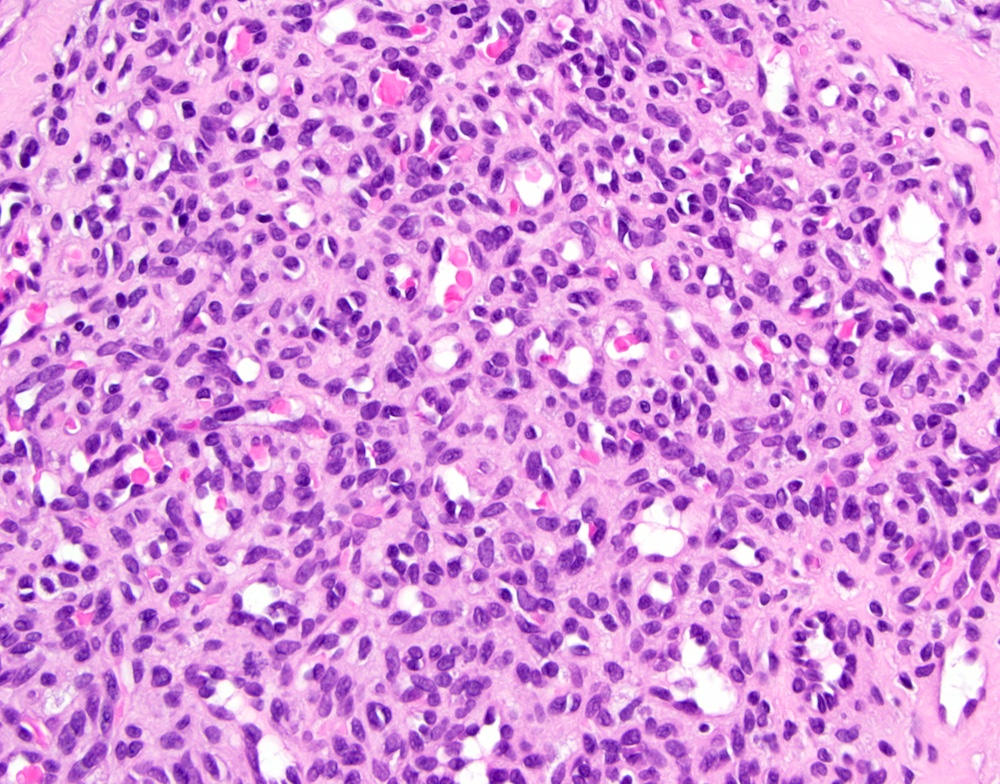  Oral Pyogenic Granuloma Histology Pyogenic Granuloma (Lobular Motiv 