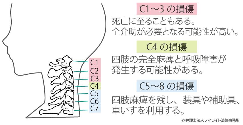 頚髄損傷 レベル – 頚髄損傷 感覚障害 – KZEOL