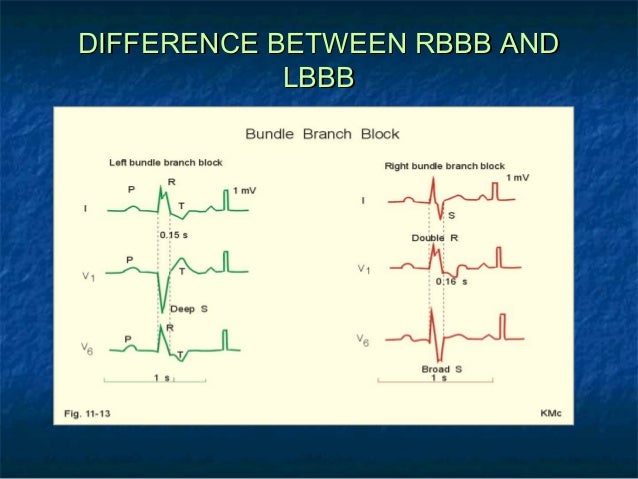  Right bundle branch block Illustration 